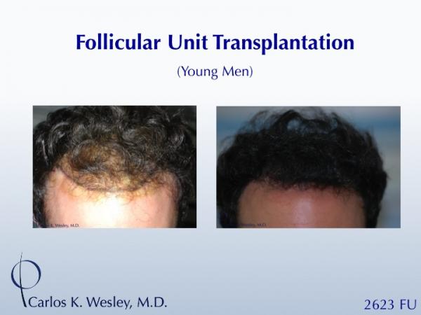 An interactive before/after of this patient can be viewed at:
http://www.drcarloswesley.com/frontal_10.html

This 26-yr-old man was referred by his hairdresser after attempting Propecia for over 3 years with minimal effect. A session of 2632 micrografts throughout his frontal third effectively strengthened his hairline and framed his face.