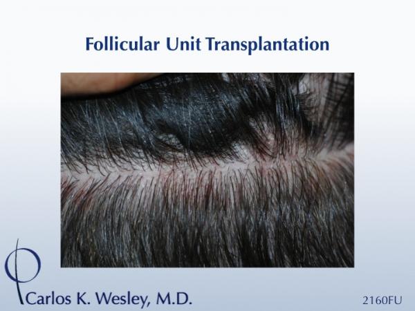 Donor scar after 2160 grafts
Dr. Carlos K. Wesley in New York City