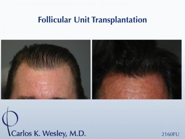 Before/After 2160 grafts
Dr. Carlos K. Wesley in New York City