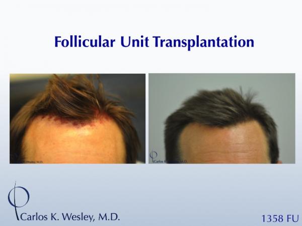 Before/After 1358 grafts to hairline and part line with Dr. Wesley in NYC.