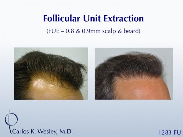This patient had 1283 FUE grafts from beard and scalp with Dr. Carlos K. Wesley in NYC.

An interactive before/after image can be viewed here:
www.drcarloswesley.com/improve_density04.html

A video of this patient's experience can be viewed here:
www.drcarloswesley.com/videos_08.html