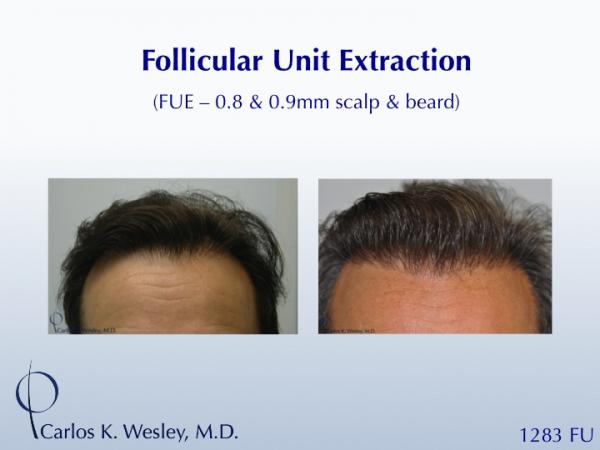 This patient had 1283 FUE grafts from beard and scalp with Dr. Carlos K. Wesley in NYC.

An interactive before/after image can be viewed here:
www.drcarloswesley.com/improve_density04.html

A video of this patient's experience can be viewed here:
www.drcarloswesley.com/videos_08.html