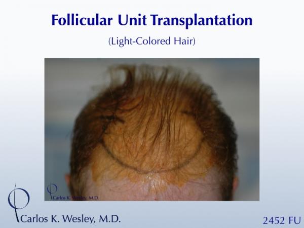 This patient can be seen before a 2452 grafts session with Dr. Wesley's office in NYC.

An interactive before/after image of this patient can be viewed at:
www.drcarloswesley.com/frontal_15.html