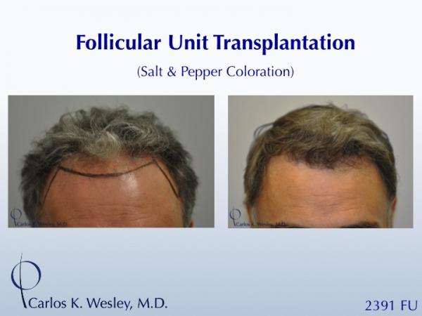 This patient is seen Before/After a 2391 graft
session with Carlos K. Wesley, M.D.

An interactive Before/After image of this patient can be viewed here:
www.drcarloswesley.com/frontal_08.html

A video of this patient's experience can be viewed here:
www.drcarloswesley.com/videos_09.html