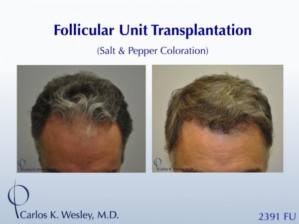 This patient is seen Before/After a 2391 graft
session with Carlos K. Wesley, M.D.

An interactive Before/After image of this patient can be viewed here:
www.drcarloswesley.com/frontal_08.html

A video of this patient's experience can be viewed here:
www.drcarloswesley.com/videos_09.html