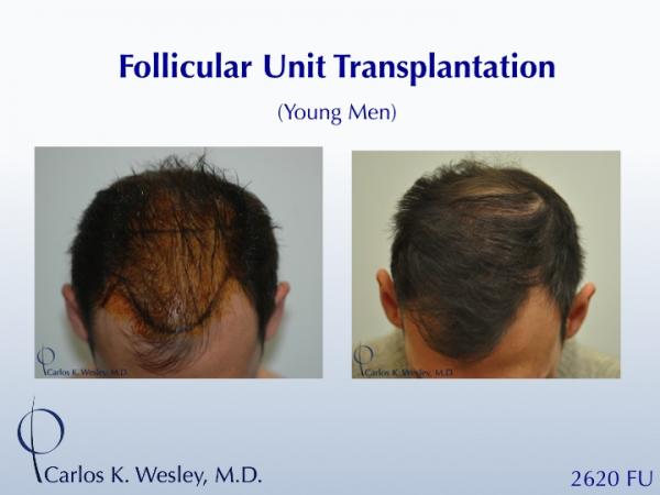 A 26-yr-old male Before/After 2060 grafts from Dr. Carlos K. Wesley.

An interactive Before/After image can be viewed here:
www.drcarloswesley.com/frontal_18.html