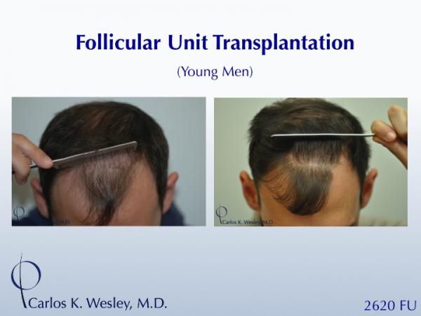 A 26-yr-old male Before/After 2060 grafts from Dr. Carlos K. Wesley.

An interactive Before/After image can be viewed here:
www.drcarloswesley.com/frontal_18.html