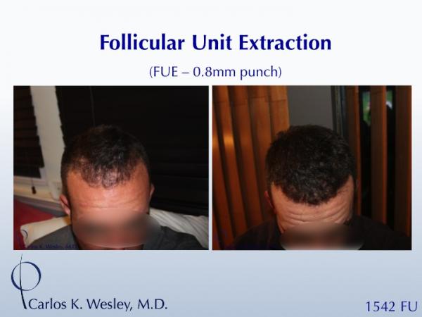 FUE with 0.75mm punch
Dr. Wesley's patient submitted his own images from home.
A video of this patient's experience can be viewed here:
www.drcarloswesley.com/videos_16.html