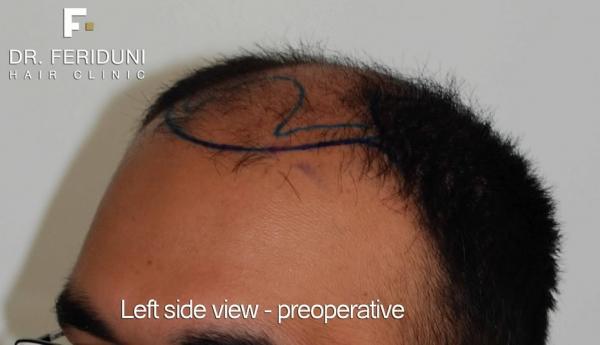 Image uploaded by: Dr Bijan Feriduni Hair Clinic