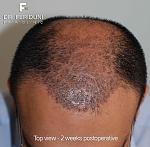 Image uploaded by: Dr Bijan Feriduni Hair Clinic