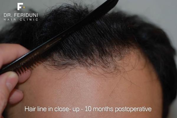 Image uploaded by: Dr Bijan Feriduni Hair Clinic