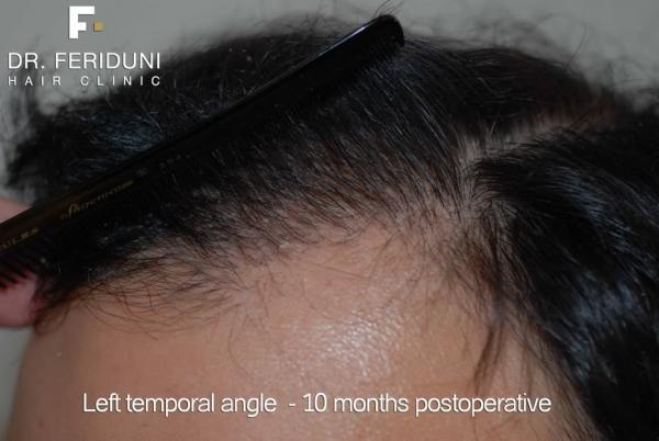 Image uploaded by: Dr Bijan Feriduni Hair Clinic