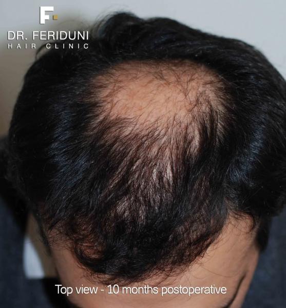 Image uploaded by: Dr Bijan Feriduni Hair Clinic