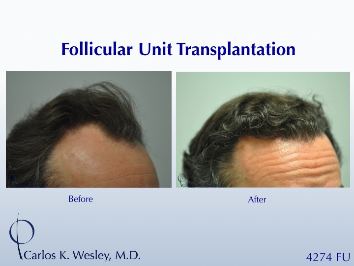 Before/After images of this 50-yr-old patient after a 4250-graft treatment by Dr. Carlos K. Wesley.  A video of his transformation may be viewed at https://vimeo.com/68961213