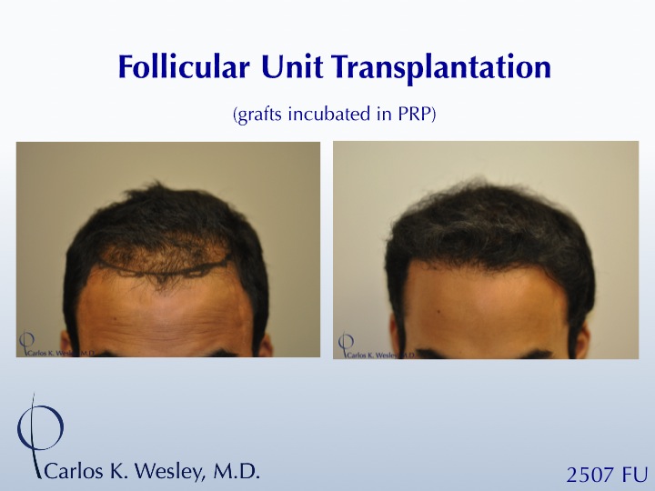 22-year-old male before and after 2507 grafts to the frontal third of his scalp by Dr. Carlos K. Wesley.  A video montage of his transformation can be viewed at: https://vimeo.com/65639952