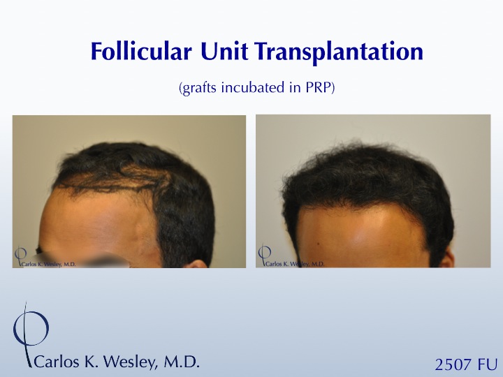 22-year-old male before and after 2507 grafts to the frontal third of his scalp by Dr. Carlos K. Wesley.  A video montage of his transformation can be viewed at: https://vimeo.com/65639952