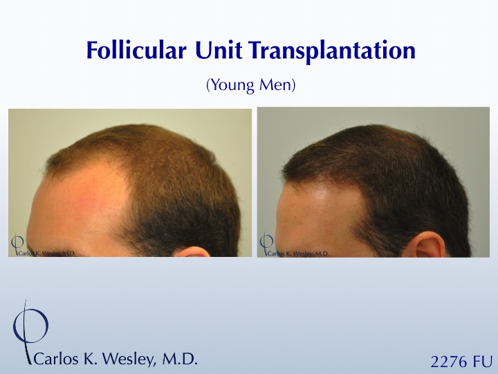 This 28-year-old desired the most natural appearing surgical hair restoration. He elected to have a session with Dr. Carlos K. Wesley in New York City. His 2276-graft session covered the frontal half of his scalp and he returned approximately nine (9) months later for images to be taken.  

View his transformation at: https://vimeo.com/67247877