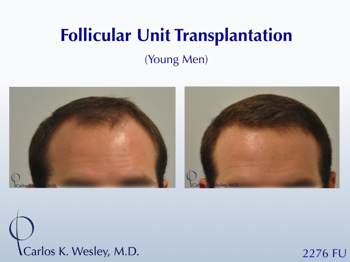 This 28-year-old desired the most natural appearing surgical hair restoration. He elected to have a session with Dr. Carlos K. Wesley in New York City. His 2276-graft session covered the frontal half of his scalp and he returned approximately nine (9) months later for images to be taken.  

View his transformation at: https://vimeo.com/67247877