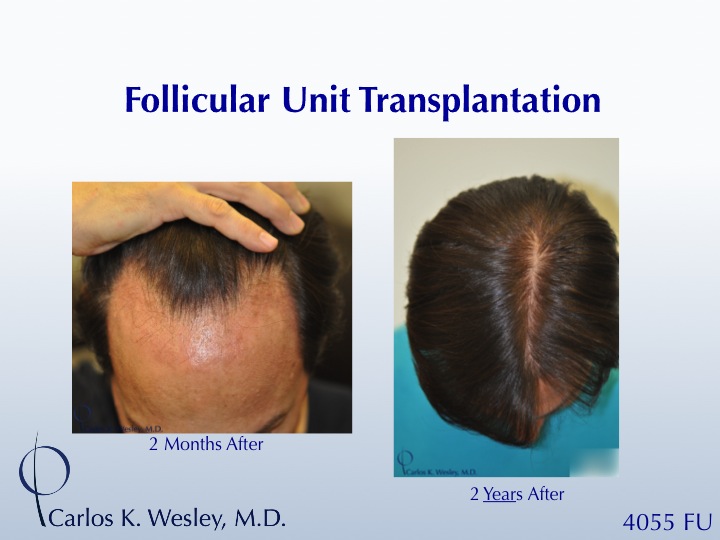 Timeline images (2 months vs 2 years) after 4055 grafts with Dr. Carlos K. Wesley in New York City.

To view this patient's transformation, please visit: https://vimeo.com/64922030