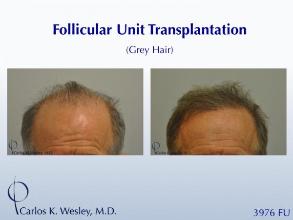 Before/After a treatment with 3976 grafts by Dr. Carlos K. Wesley in New York City.

A video of this patient's transformation may be viewed here:
https://vimeo.com/68079586