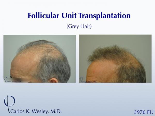 Before/After a treatment with 3976 grafts by Dr. Carlos K. Wesley in New York City.

A video of this patient's transformation may be viewed here:
https://vimeo.com/68079586