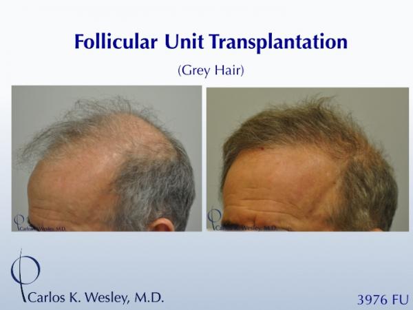 Before/After a treatment with 3976 grafts by Dr. Carlos K. Wesley in New York City.

A video of this patient's transformation may be viewed here:
https://vimeo.com/68079586