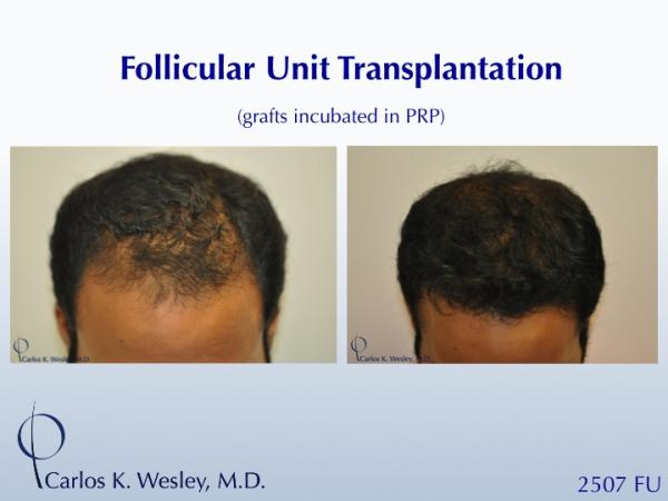 22-year-old male before and after 2507 grafts to the frontal third of his scalp by Dr. Carlos K. Wesley. 

A video montage of his transformation can be viewed at: https://vimeo.com/65639952