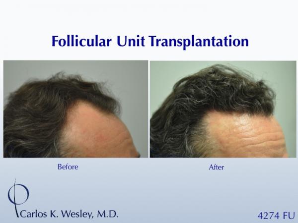 Before/After images of this 50-yr-old patient after a 4250-graft treatment by Dr. Carlos K. Wesley. 

A video of his transformation may be viewed at https://vimeo.com/68961213