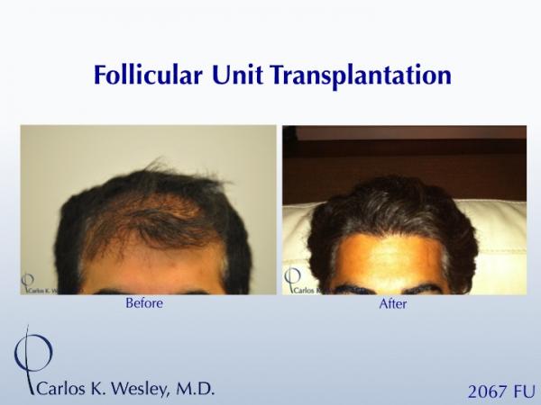 Before/After images of this 35-yr-old patient after a 2567-graft treatment by Dr. Carlos K. Wesley. 

A video of his transformation may be viewed at:
https://vimeo.com/54334747