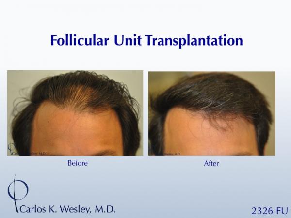 Here is a 42-year-old man who wanted the fullness of his hairline back.  The results of a 2326-graft session with Dr. Wesley can be seen at 11 months after his surgery.  The patient is ecstatic.

a video of his transformation may be viewed at https://vimeo.com/70521041