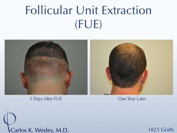 An example of short-term donor area recovery after follicular unit extraction (FUE) with Dr. Carlos K. Wesley (NYC).

A video montage of many more patients' FUE donor recoveries may be viewed at https://vimeo.com/70354892