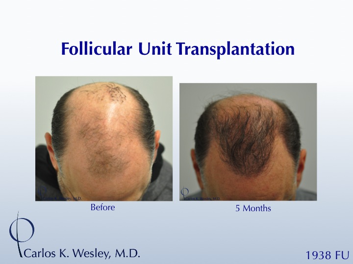 This patient presented to Dr. Carlos K. Wesley for a repair of work performed many years prior at a different clinic.  A video of his transformation may be viewed here:

https://vimeo.com/50257292

An interactive before/after image may be viewed here:
http://www.drcarloswesley.com/soften_a_pluggy_appearance03.html
