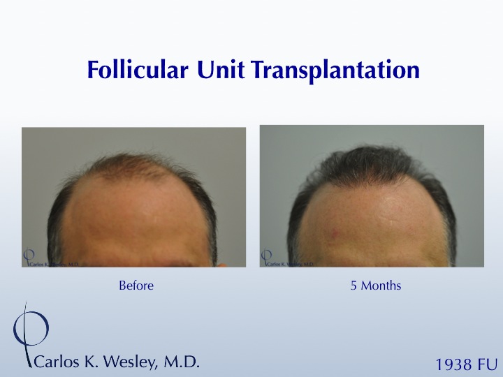This patient presented to Dr. Carlos K. Wesley for a repair of work performed many years prior at a different clinic.  A video of his transformation may be viewed here:

https://vimeo.com/50257292

An interactive before/after image may be viewed here:
http://www.drcarloswesley.com/soften_a_pluggy_appearance03.html