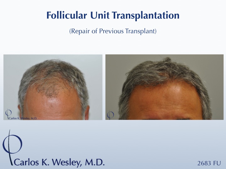 This patient presented to Dr. Carlos K. Wesley (NYC) after having undergone a hair transplant session at a different NYC surgical office.  His session with Dr. Wesley resulted in markedly more hair growth.

A video of this patient's transformation may be viewed here: https://vimeo.com/38505941
