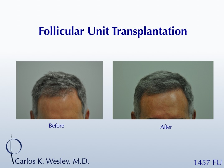 This patient presented to Dr. Carlos K. Wesley (NYC) after having undergone a hair transplant session at a different surgical office.  He was please when his session with Dr. Wesley resulted in markedly more hair growth.

An interactive before/after image of this patient may be viewed here: http://www.drcarloswesley.com/mafrontal.html