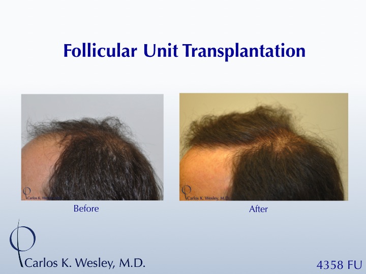 This patient's session with Carlos K. Wesley, M.D. (NYC) addressed both the frontal and mid scalp portions of his scalp.