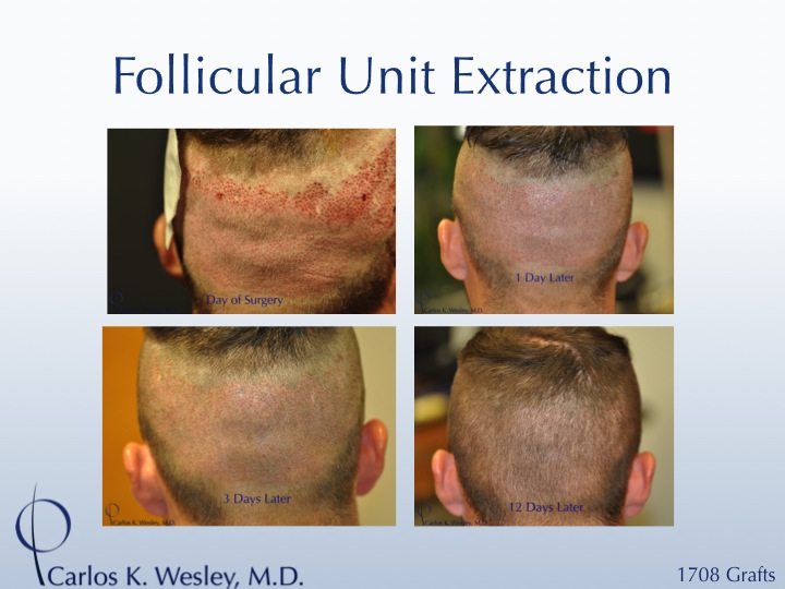 More examples of Dr. Wesley's patients' FUE donor recovery processes can be viewed in this video montage:

https://vimeo.com/70354892