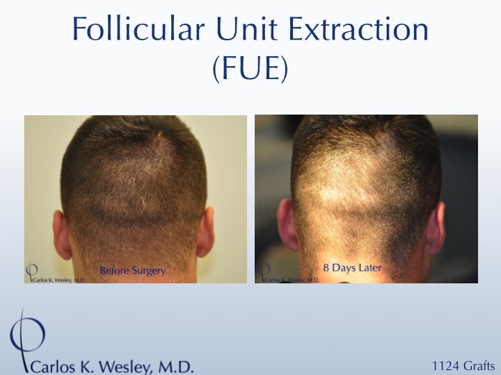 More examples of Dr. Wesley's patients' FUE donor recovery processes can be viewed in this video montage:

https://vimeo.com/70354892