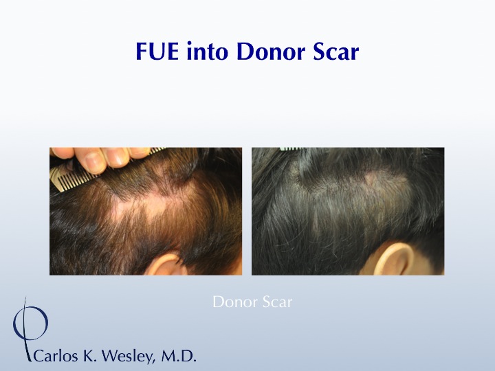 Donor scar repair by Dr. Wesley using FUE into scar tissue.