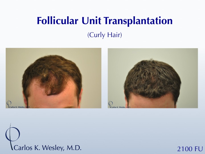 2100 Grafts throughout the frontal half.  The grafts were incubated in PRP prior to transplantation.