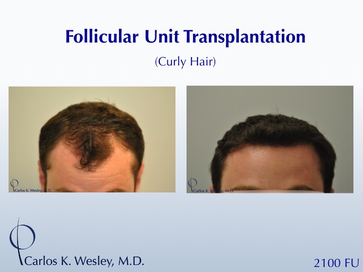 2100 Grafts throughout the frontal half.  The grafts were incubated in PRP prior to transplantation.