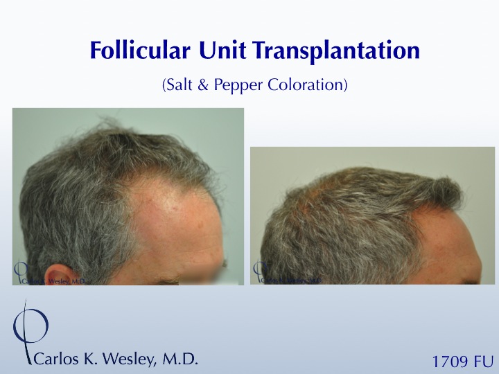 A video montage of this patient's transformation may be viewed here:

https://vimeo.com/67214017