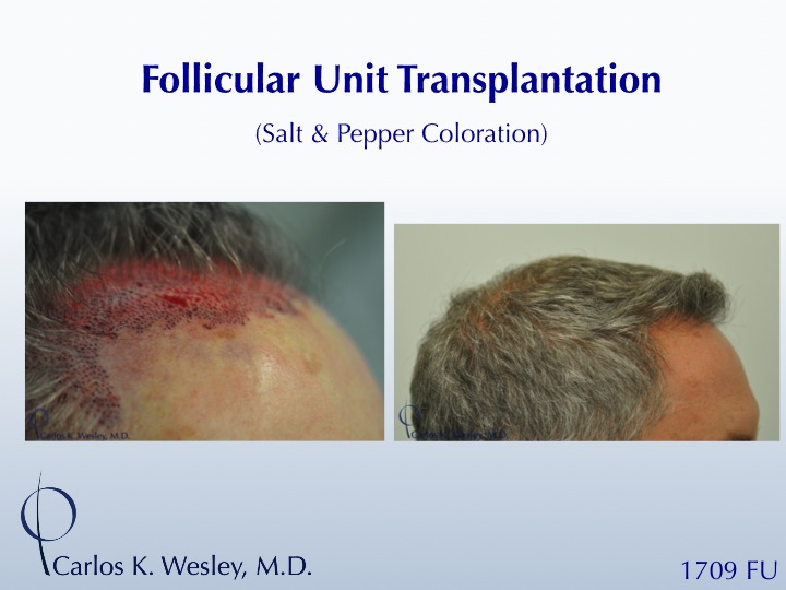 A video montage of this patient's transformation may be viewed here:

https://vimeo.com/67214017