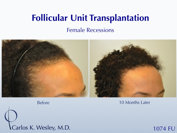 An interactive video montage of this patient may be viewed here: 

https://vimeo.com/39201138

An interactive before/after image of this female patient of Dr. Carlos K. Wesley (NYC) may be viewed here:

http://www.drcarloswesley.com/hairline02.html