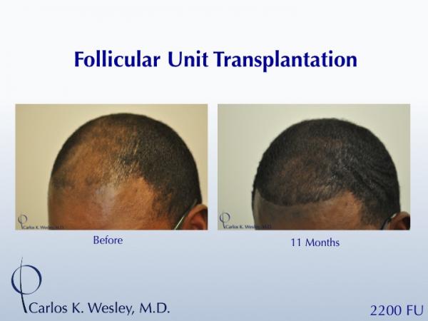 African-American male in his 30s underwent surgical hair restoration with Dr. Wesley (NYC).  Before and 11 months after a 2200 FU session.