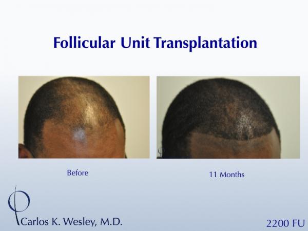 African-American male in his 30s underwent surgical hair restoration with Dr. Wesley (NYC).  Before and 11 months after a 2200 FU session.
