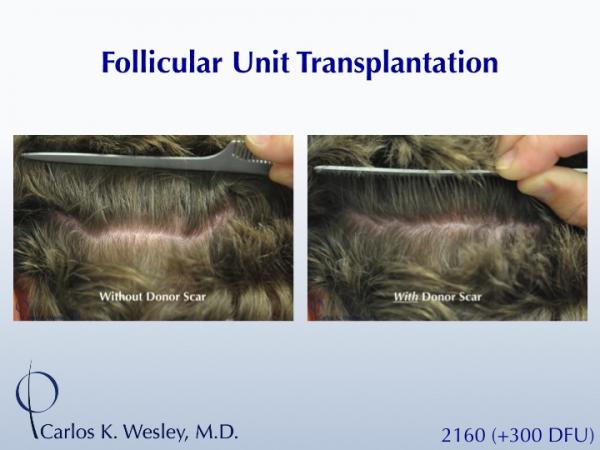 This 40-year old underwent surgical hair restoration with Dr. Carlos K. Wesley (NYC).  He received 2460 grafts (300 of which were DFUs) and presented 10 months postoperatively.