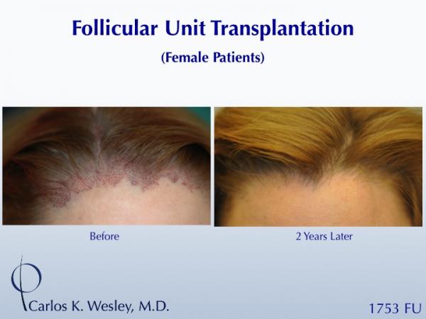 A 32-year-old female visited the office of Dr. Carlos K. Wesley with the desire to fill in her hairline. He performed a 1753 FU session and she returned approximately two years later for follow up images.