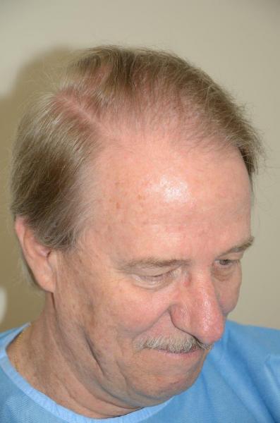Side view after 2600 hair transplant grafts.