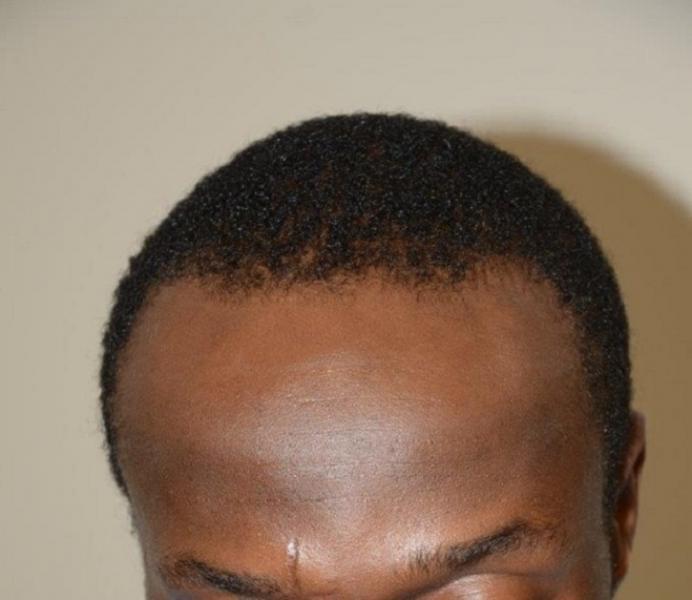 Before Surgical Hairline Advancement.